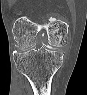 Figure 4 for case Medial meniscus tear ( RID2772 )